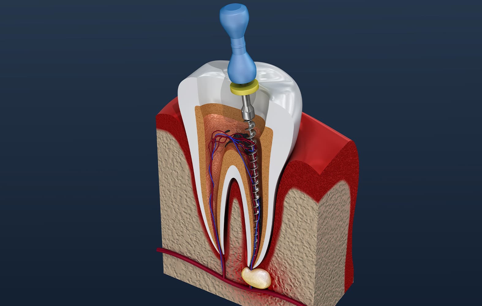 Restoratif ve Endodonti Tedaviler
